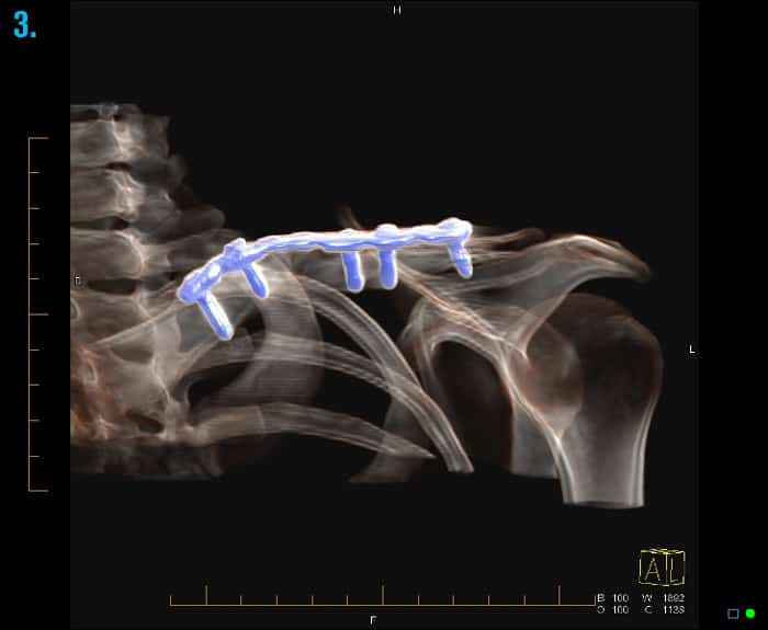 CT scan of a clavicle