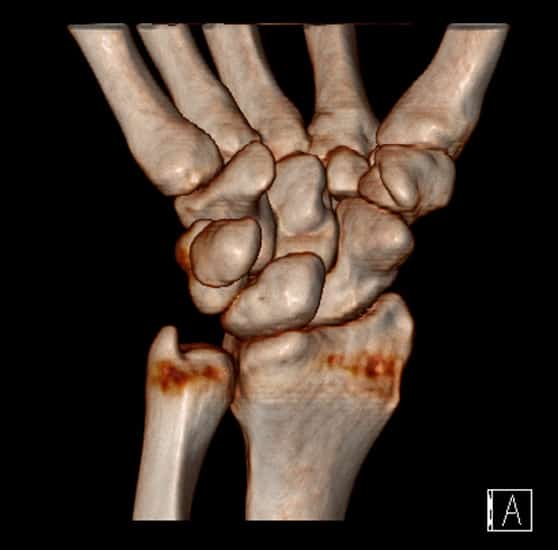 CT scan of a wrist