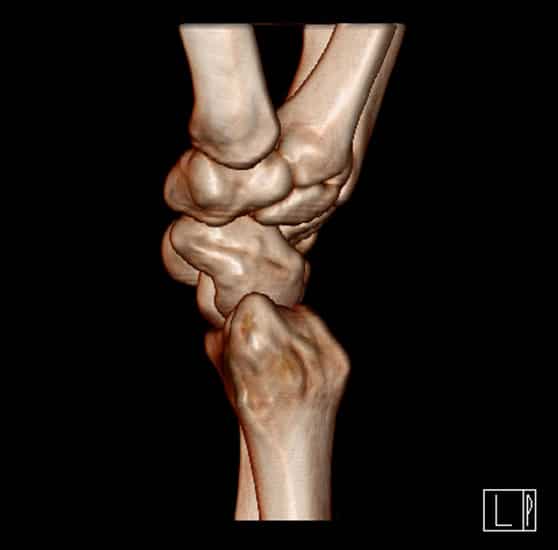 CT scan of a wrist