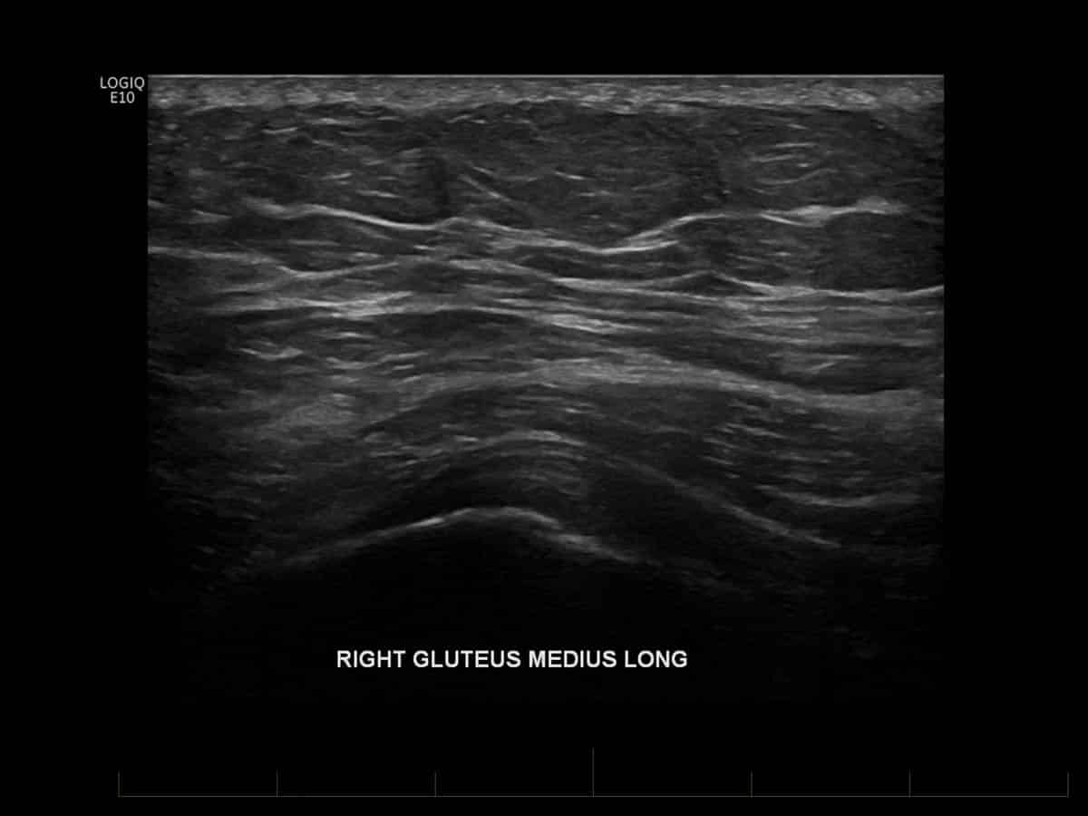 Longitudinal (long axis) ultrasound examination of the lateral aspect of the hip demonstrates a normal appearing gluteus medius tendon (arrow).