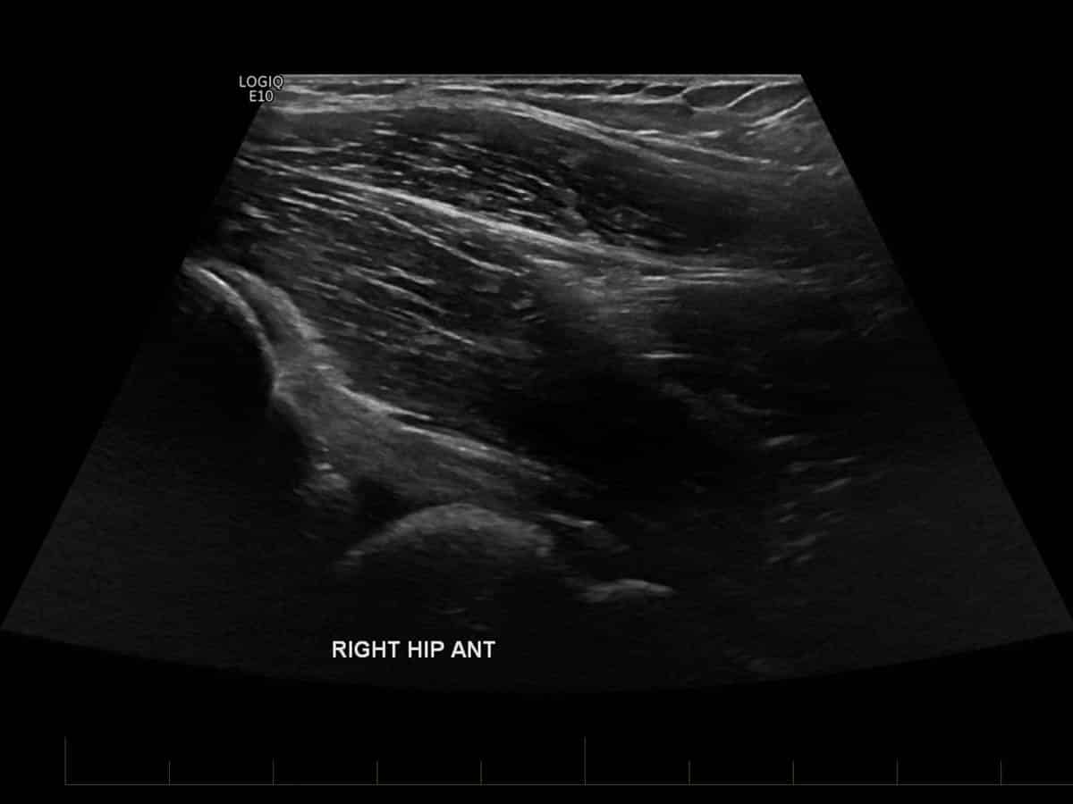 Longitudinal (long axis) ultrasound examination of the anterior aspect of the hip demonstrates a normal appearing hip joint (arrow).