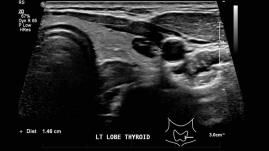 Short axis views of the left lobe of the thyroid gland demonstrates as small colloid nodule (arrow).