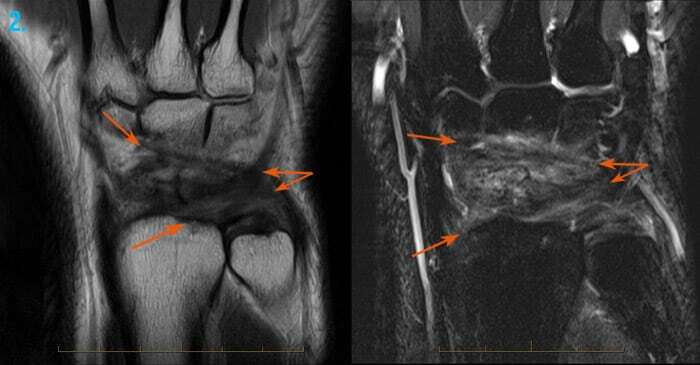 MRI of a sprained wrist