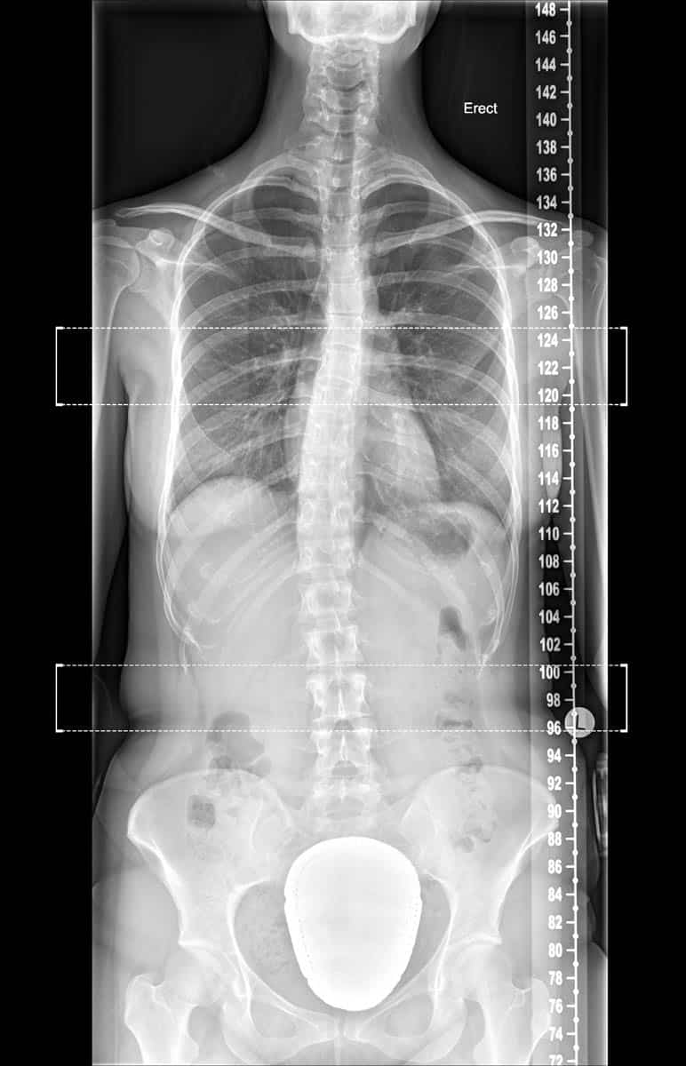 Full Spine X-ray: Frontal radiograph of a whole spine radiograph demonstrating a mild scoliois of the mid to lower thoracic to the right.