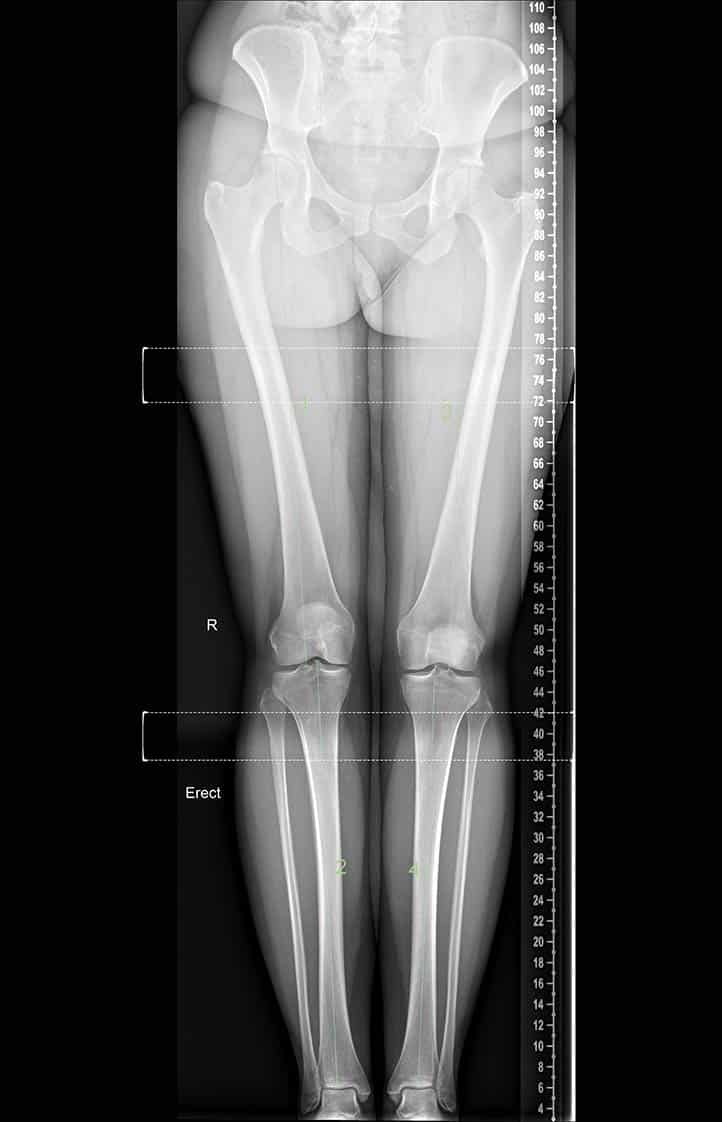 Digital X-ray - Long leg view: Frontal radiograph of a long leg views examination demonstrating normal alignment and no leg length discrepancy.