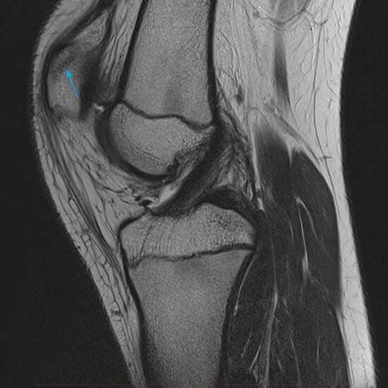 MRI of a child's kneecap