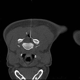 CT scan of a cervical epidural injection