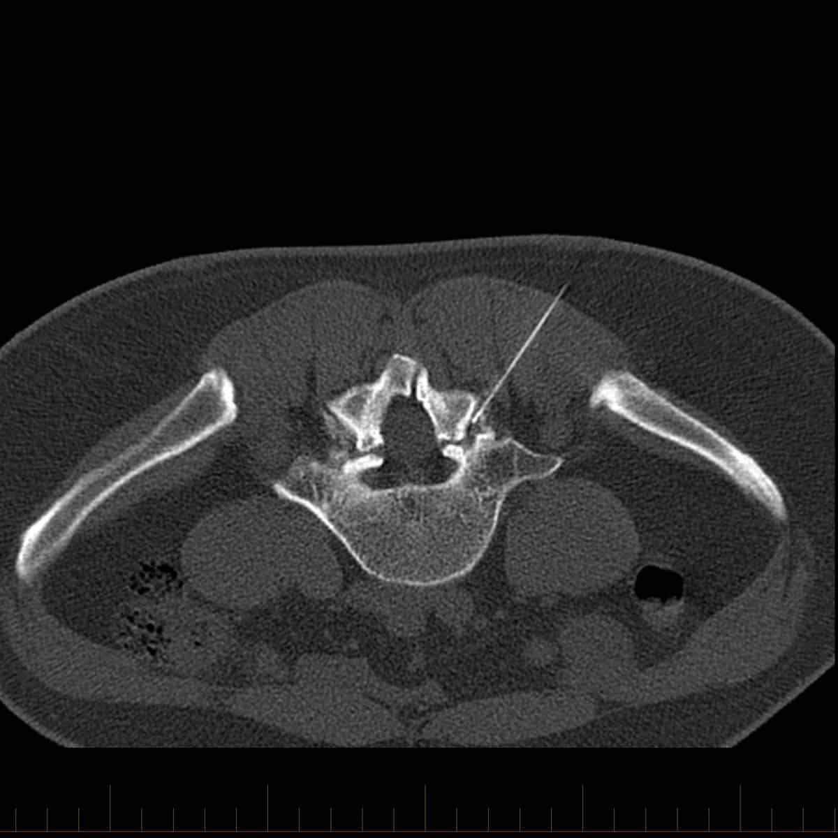 CT scan of pars defect injection