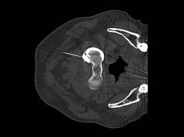 CT guided C1/2 facet joint injection with contrast demonstrating intra-articular position - 1A