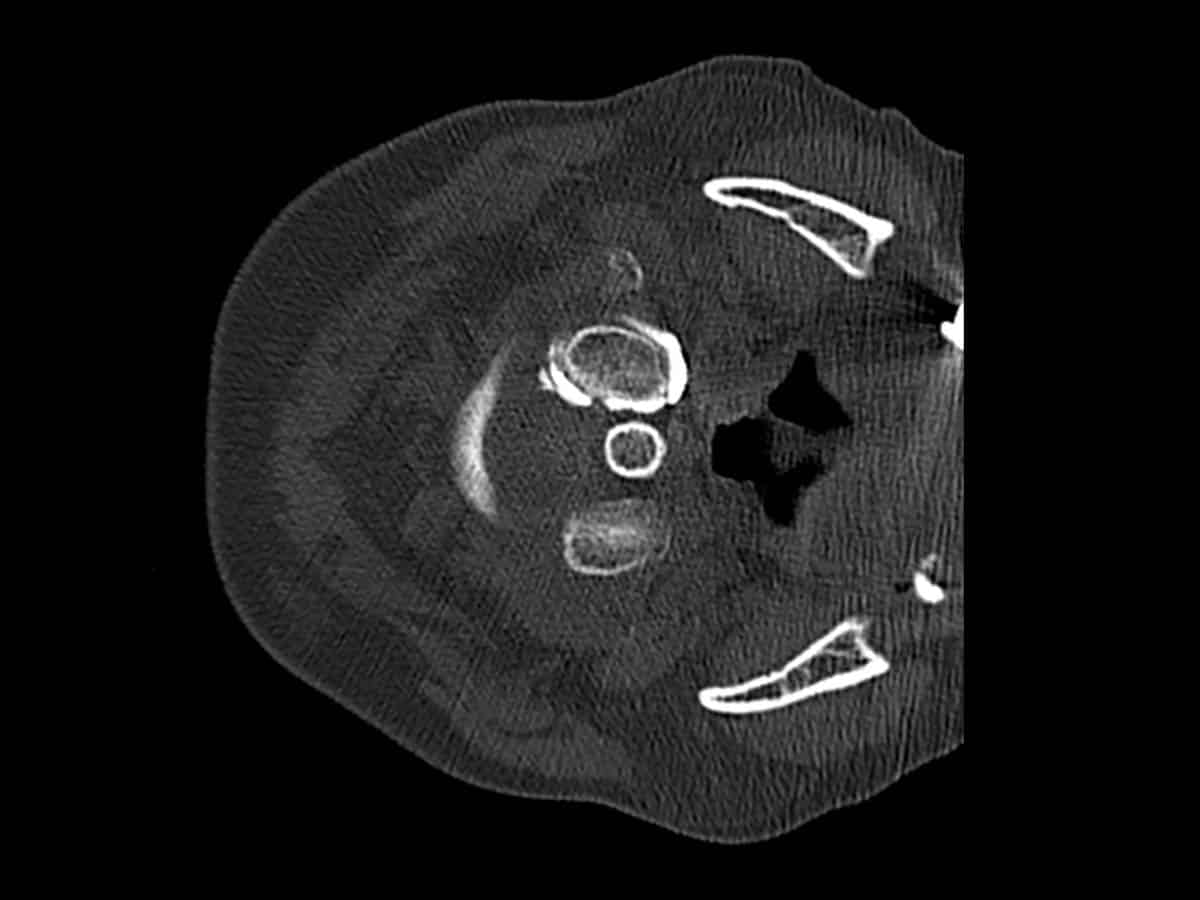 CT guided C1/2 facet joint injection with contrast demonstrating intra-articular position - 1B