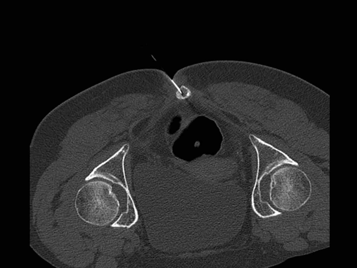 CT guided sacrococygeal joint injection with cortisone