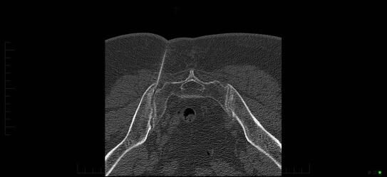 CT scan of a sacroiliac joint injection