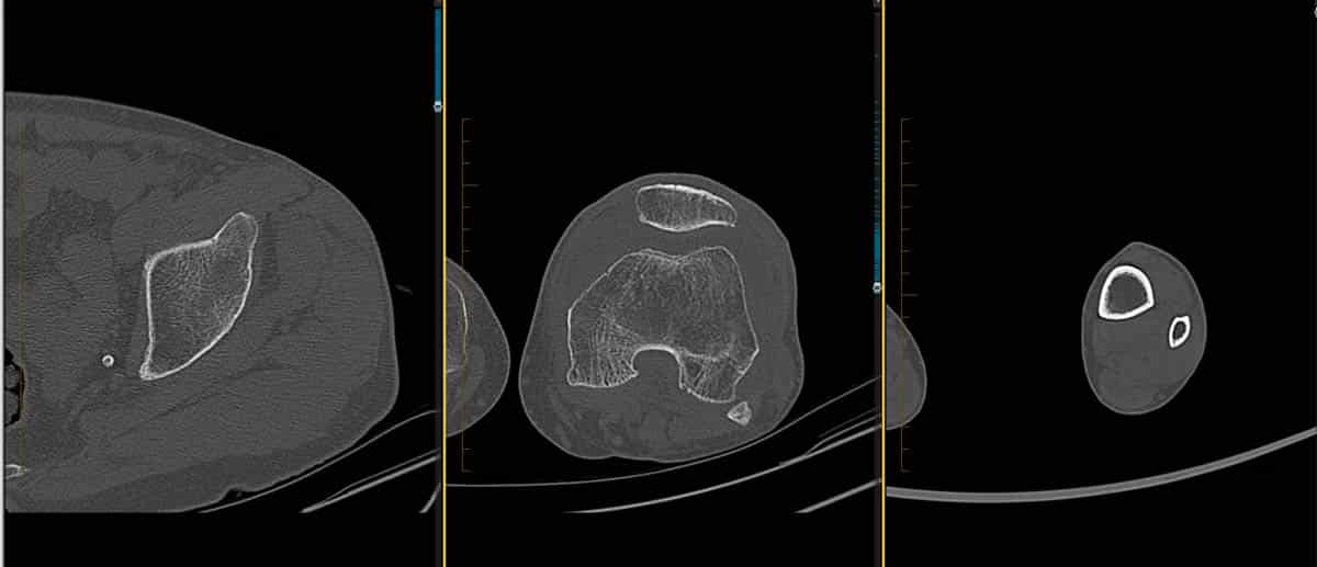 CT scans of a knee joint replacement