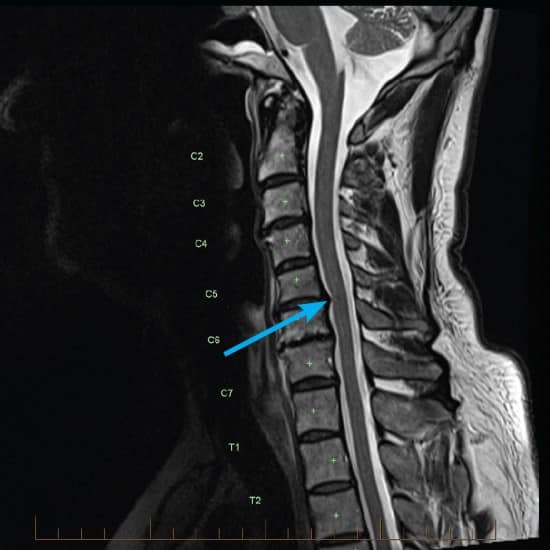 MRI of a cervical spine