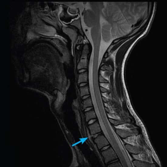 MRI of a cervical spine trauma