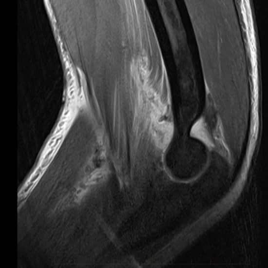 MRI of a 15 years old's elbow