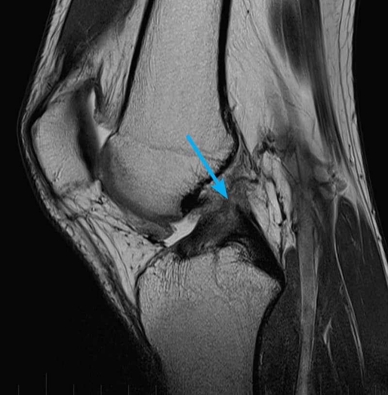 MRI of a knee with ACL tear