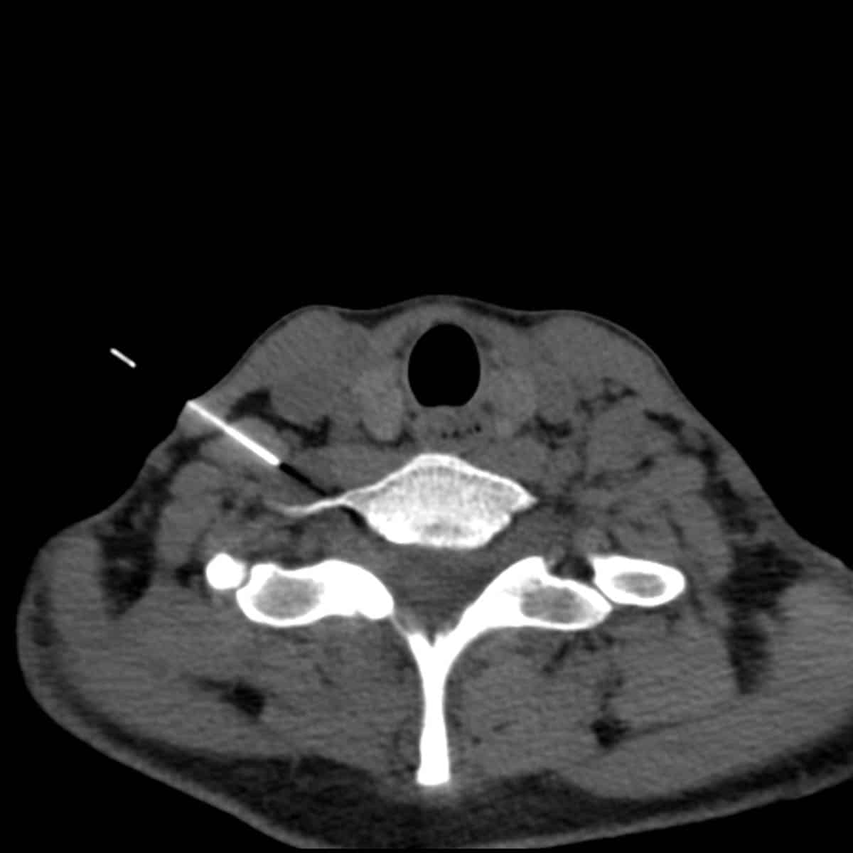 CT guided botox injection into scalenus anterior for thoracic outlet syndrome