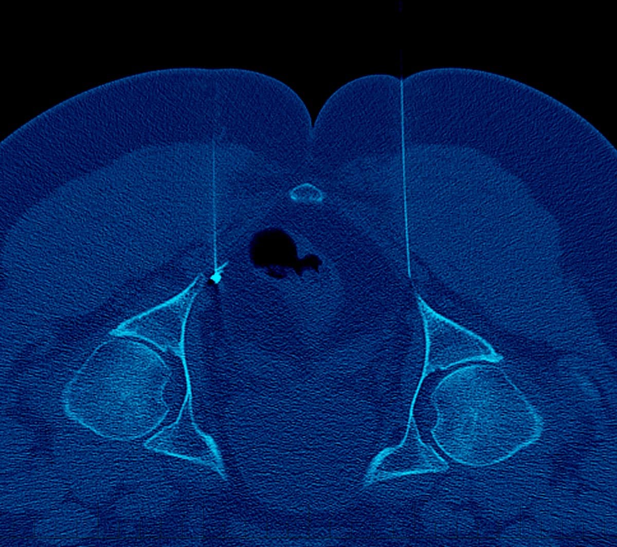 Nerve Blocks - CT guided pudendal nerve block