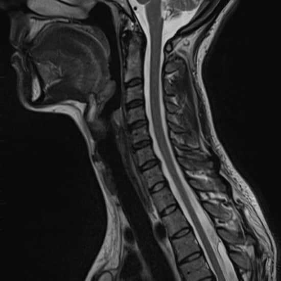 paediatric MRI of a spine