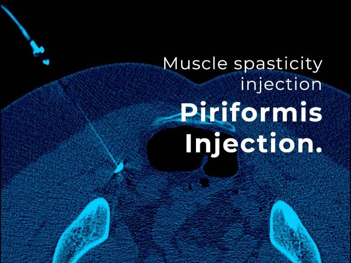 Piriformis Botox Injection - Melbourne Radiology