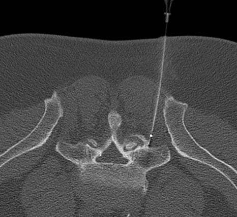 Radiofrequency Ablation – Performed with CT imaging guidance – right L5 medial branch