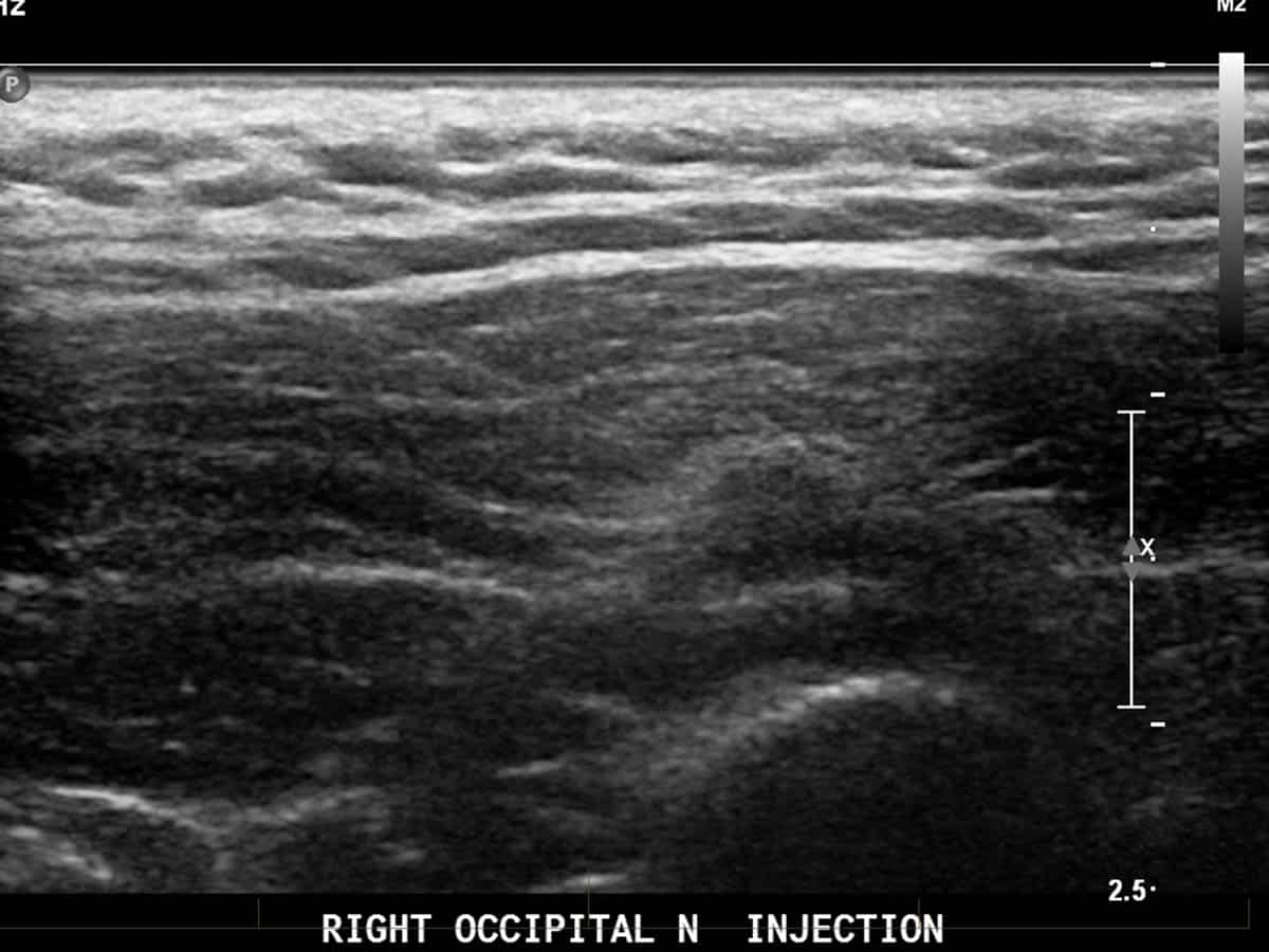 Ultrasound guided greater occipital nerve (GON) injection