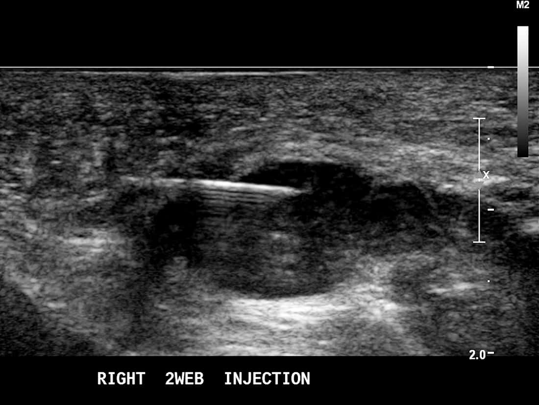 Ultrasound guided RFA to treat Morton's neuroma