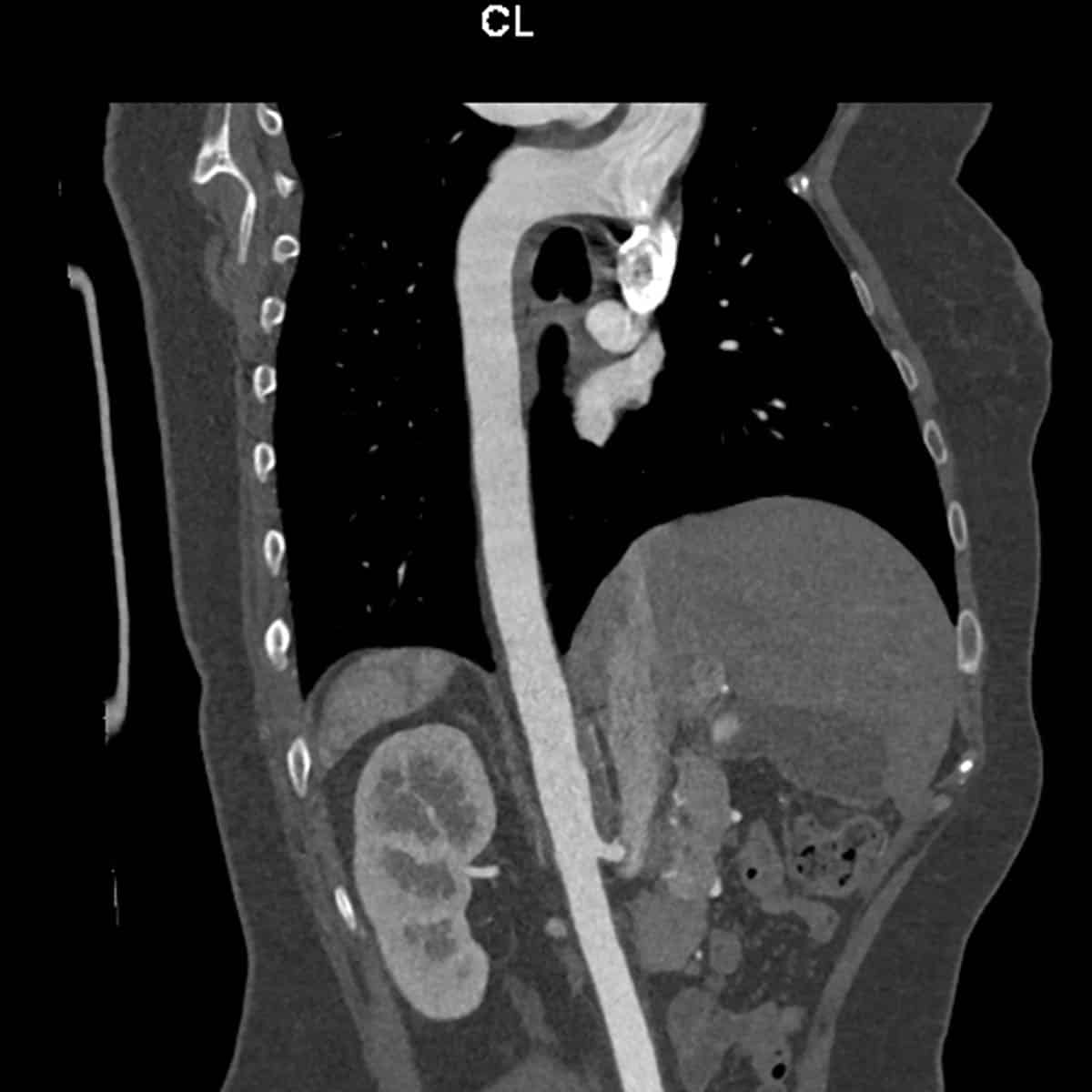 CT scan of a thoracic aorta angiogram
