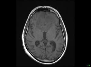 melbourne-radiology-mri-brain-precontrast-0001