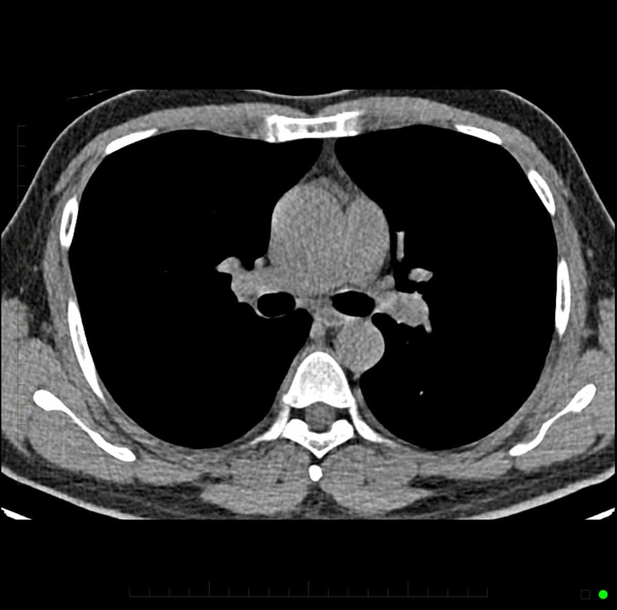 Chest CT Scan 8 - Melbourne Radiology