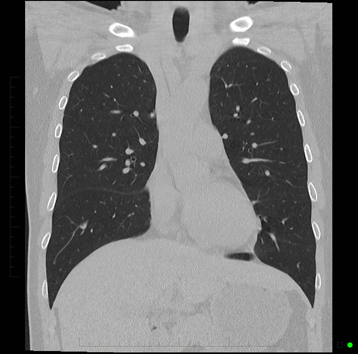 Chest CT Scan 6 - Melbourne Radiology