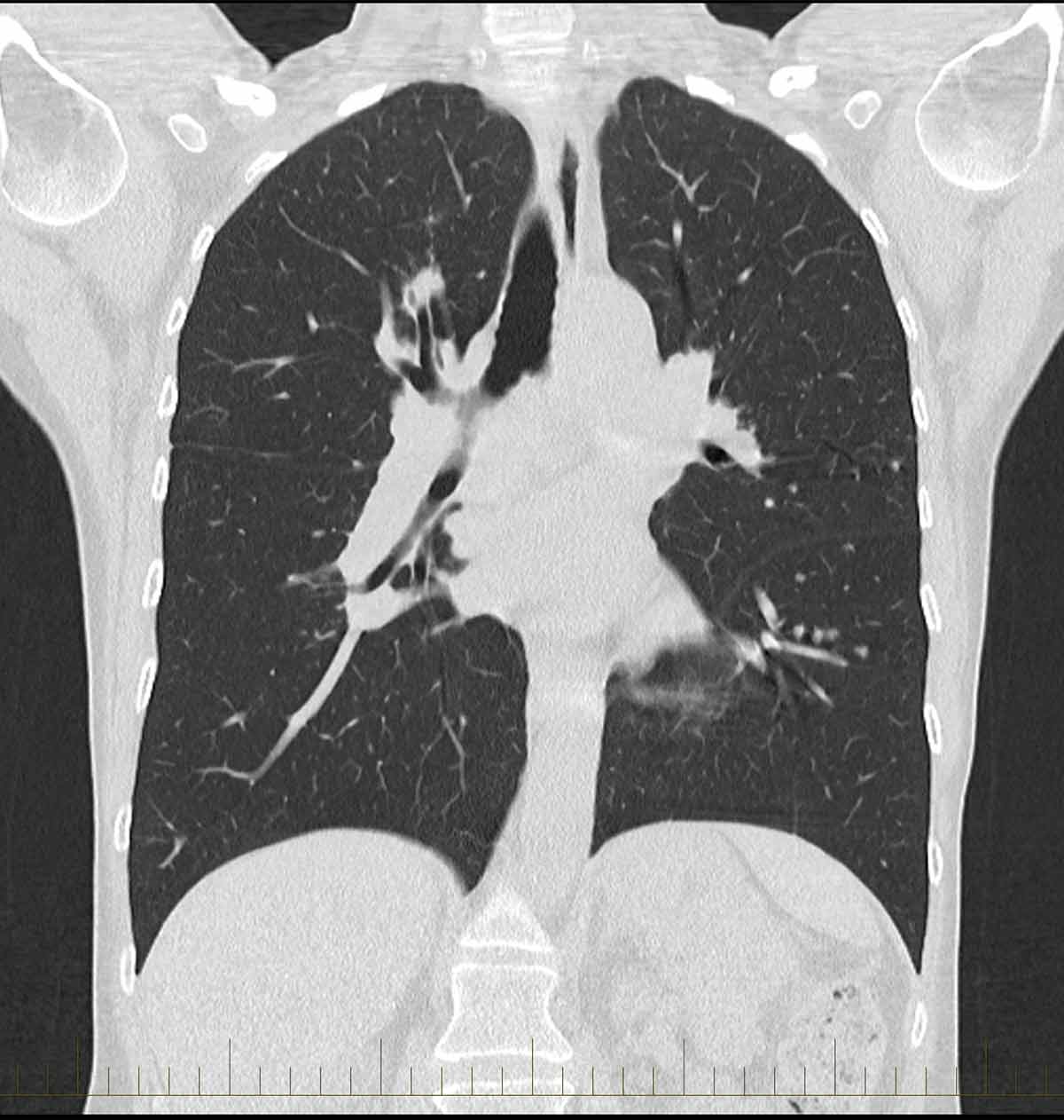 Chest CT Scan 2 - Melbourne Radiology
