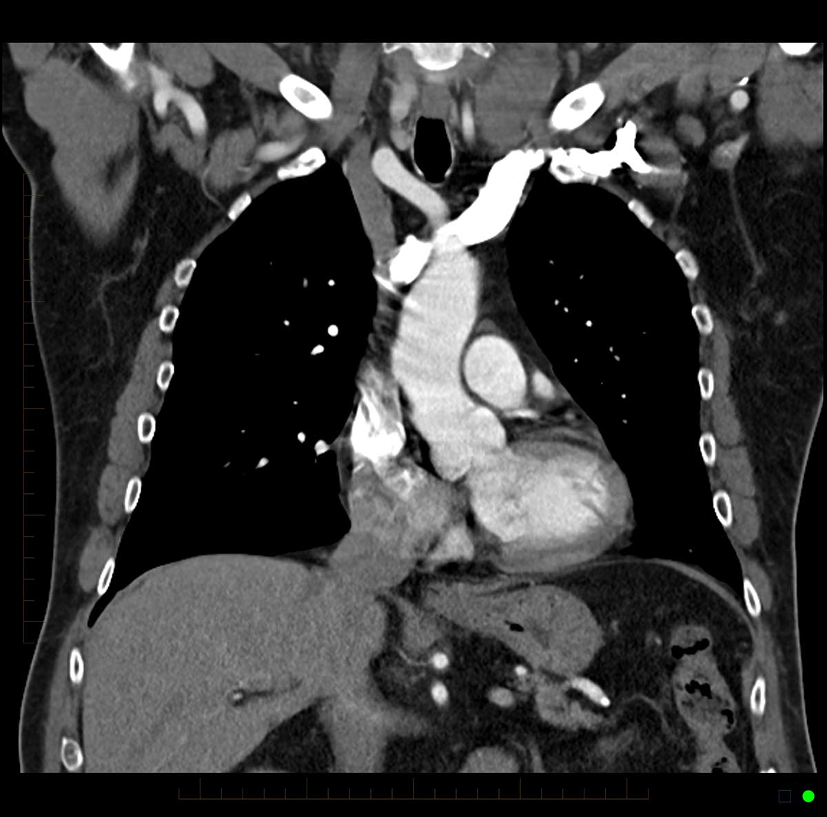 Chest CT Scan 5 - Melbourne Radiology