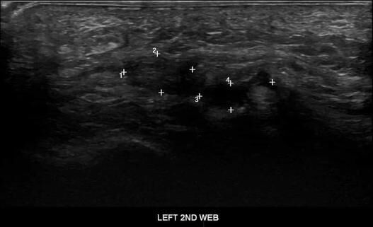 Left Foot Ultrasound 4 - Melbourne Radiology