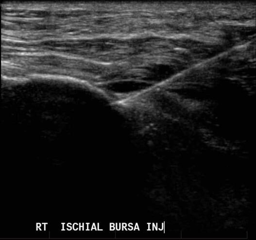 Hamstring Ultrasound 5 - Melbourne Radiology
