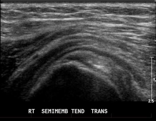 Hamstring Ultrasound 4 - Melbourne Radiology