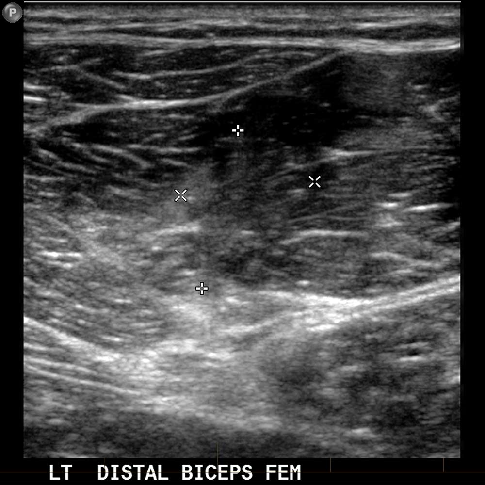 Hamstring Ultrasound 3 - Melbourne Radiology