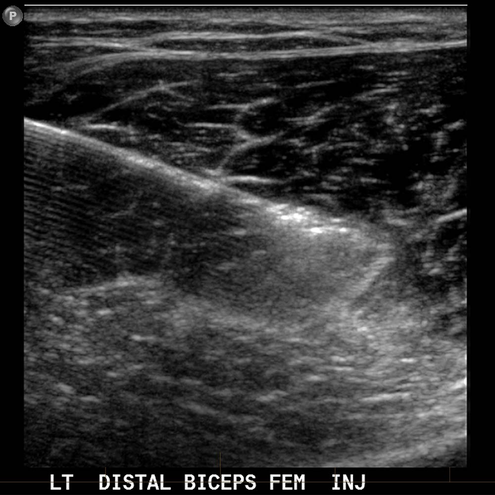 Hamstring Ultrasound 2 - Melbourne Radiology