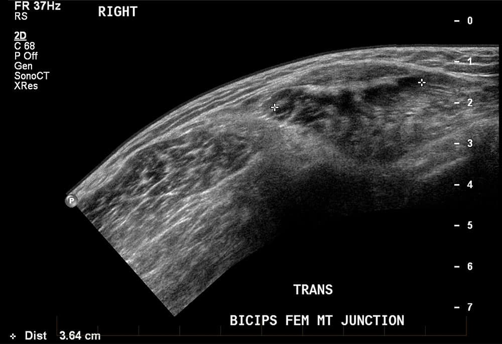 Hamstring Ultrasound - Melbourne Radiology