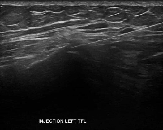 Hip Injection Ultrasound - Melbourne Radiology