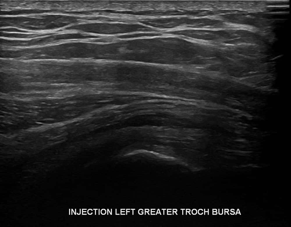 Injection Hip Ultrasound - Melbourne Radiology