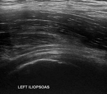 Left Hip Ultrasound 3 - Melbourne Radiology