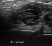 Left Hip Ultrasound 2 - Melbourne Radiology