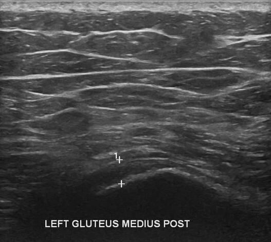 Left Hip Ultrasound - Melbourne Radiology