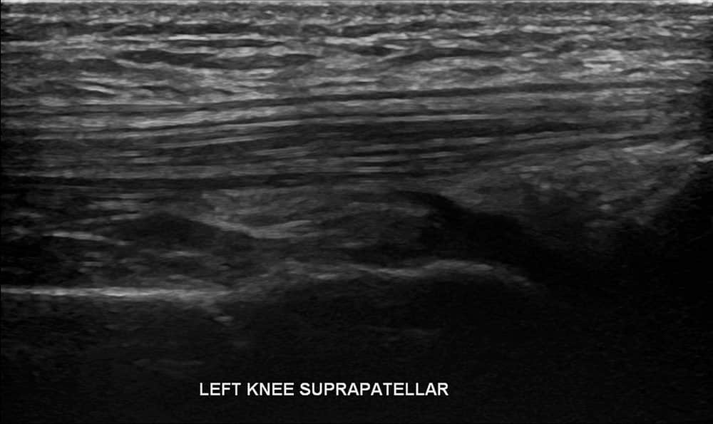 Knee Ultrasound 5 - Melbourne Radiology