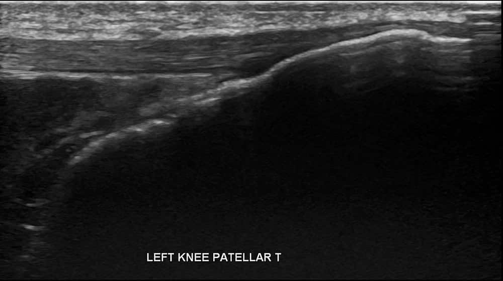 Knee Ultrasound 4 - Melbourne Radiology