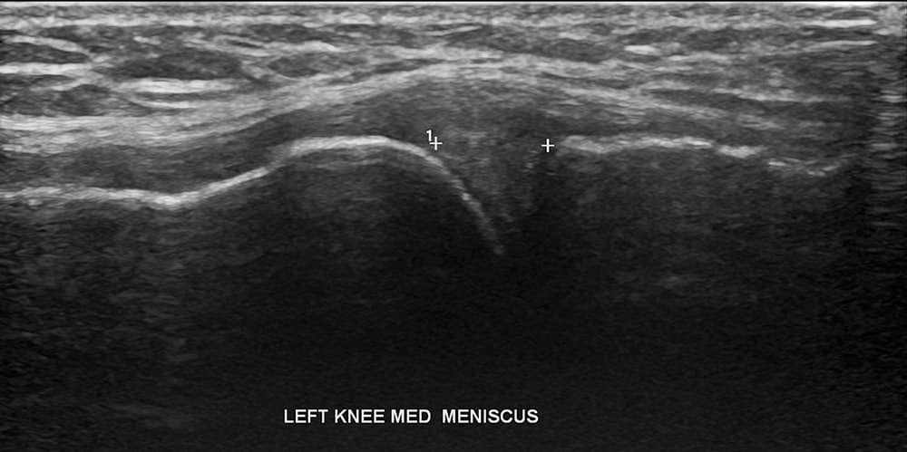Knee Ultrasound 3 - Melbourne Radiology
