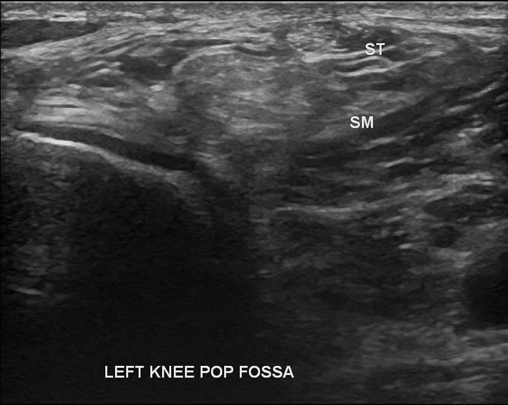 Knee Ultrasound - Melbourne Radiology