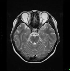 MRI brain scan with contrast 1